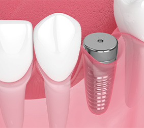 Illustration of unrestored dental implant in gums between natural teeth