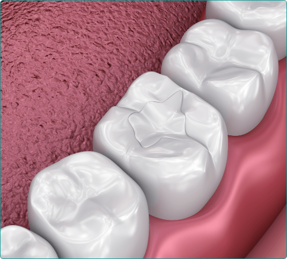 Illustrated teeth with dental sealants
