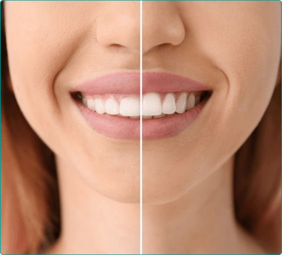 Woman smiling before and after gummy smile correction
