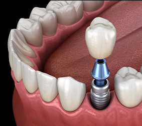 Dental crown being placed onto dental implant