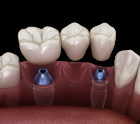 Dental bridge being placed onto two dental implants