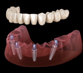 Full denture being placed onto four dental implants