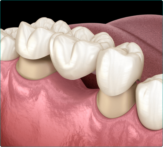 Illustrated dental bridge replacing a missing tooth