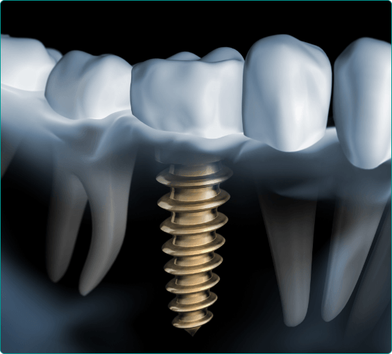 Illustrated dental implant with dental crown replacing a missing tooth