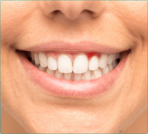 Close up of person smiling with red spot in their gums