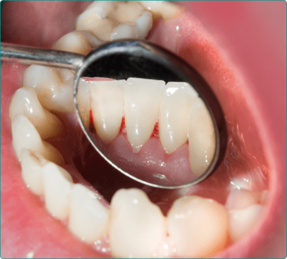 Close up of dental mirror reflecting red spot in mouth