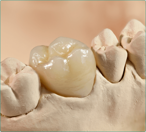 Model of mouth with dental crown atop one tooth