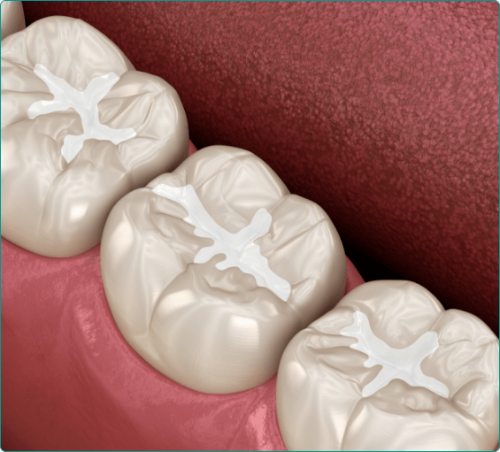 Illustrated row of teeth with tooth colored fillings