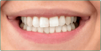 Smile with whiter teeth