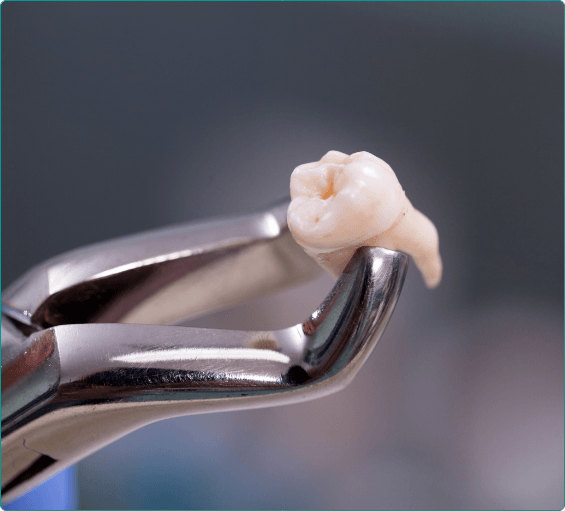 Dental forceps holding a tooth after tooth extractions in Bangor