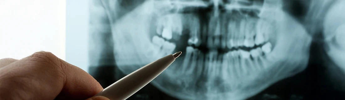 Dentist Bangor ME Doctor Pointing To Missing Tooth X-Ray Dental Technology Doctor Pointing To Missing Tooth X-Ray Dental Technology