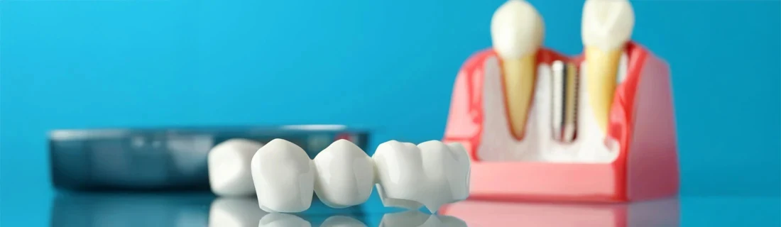 Various Methods of Replacing Teeth are Shown