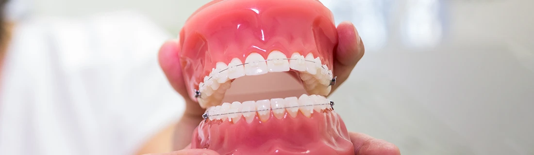FC – Achieve Optimal Alignment with Clear Braces at Creative Dental Solutions